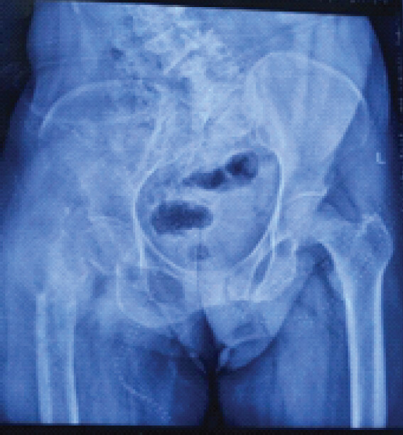 Figure 1: Radiograph of bilateral hip with pelvis of patient at presentation preoperatively showing a lytic lesion at right proximal femur with fracture neck of femur.