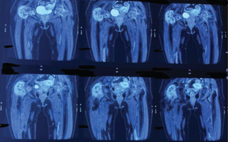 Figure 2: Coronal magnetic resonance imaging of bilateral hip and pelvis showing lytic lesion in proximal femur and fracture neck of femur right side.