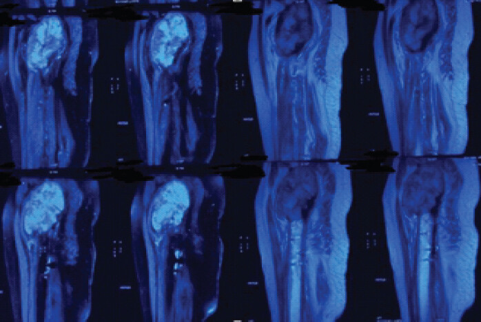 Figure 3: Sagittal view of magnetic resonance imaging of bilateral hip with pelvis showing extent of lytic lesion in anteroposterior plane in the right proximal femur.