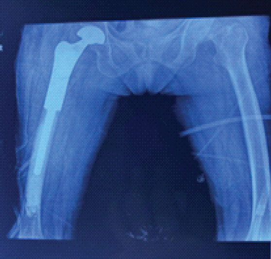 Figure 4: Post-operative radiograph of patient showing removal of lytic lesion and replacing proximal femur with mega prosthesis.