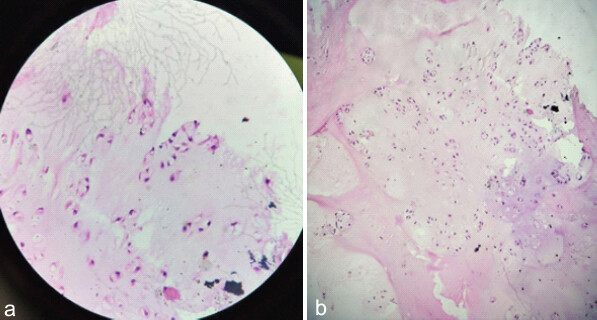 Figure 5: (a and b) Post-operative histopathological report showing grade 1 chondrosarcoma.