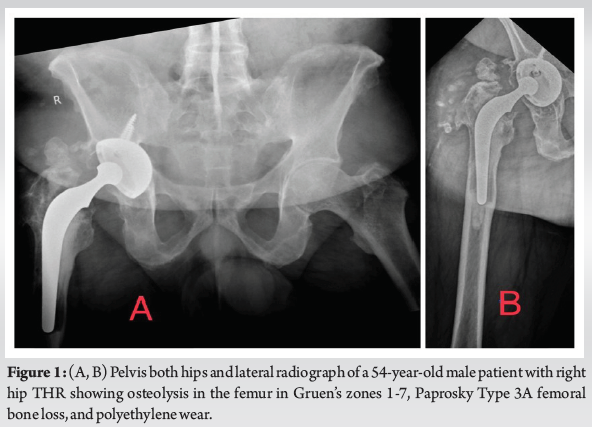 Cage Augmentation of the Retained Acetabular Shell with a Dual Mobility ...