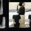 Three-Dimensional Surgical Planning and Patient-Specific Osteotomy Guide in the Management of Chronic Monteggia Fracture: A Case Report
