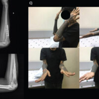 Figure 1: Anteroposterior and lateral radiograph of affected forearm pre- (a) and post-implant removal (b); (c) Clinical pictures of forearm range of motion.