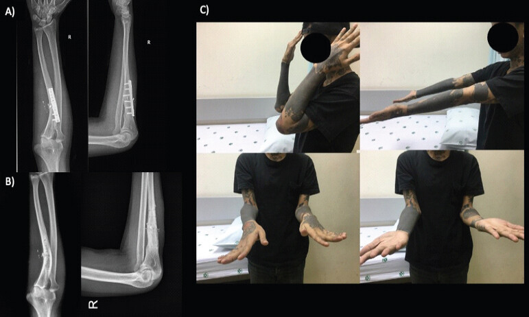 Figure 1: Anteroposterior and lateral radiograph of affected forearm pre- (a) and post-implant removal (b); (c) Clinical pictures of forearm range of motion.