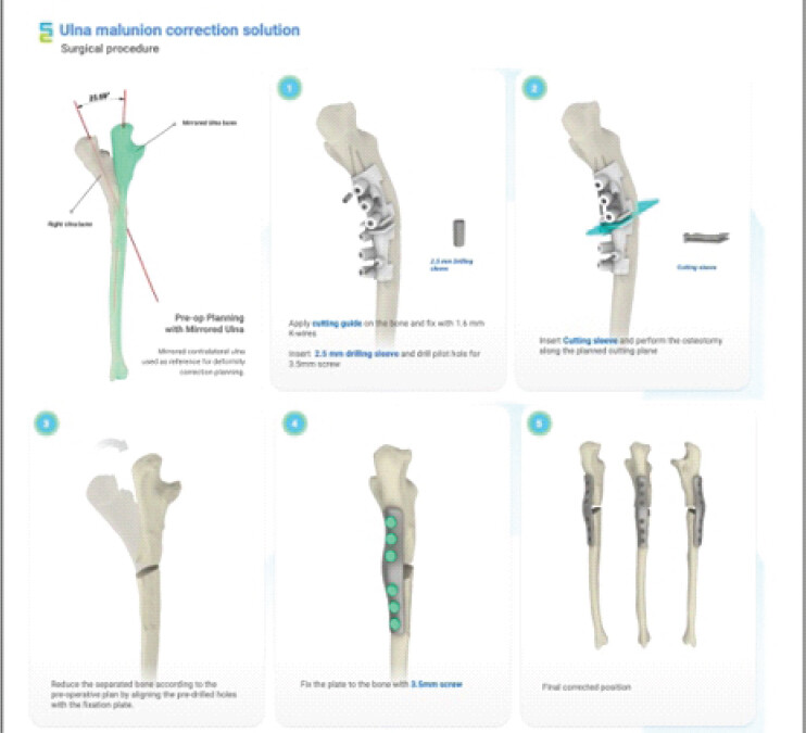 Figure 2: The surgical steps planned for corrective osteotomy using the customized surgical guide and customized bone plate. Pre-operative planning: the deformed right ulna compared with a mirrored image of the contralateral ulna as an anatomical reference, showing the required correction angle of 25.69°. (1) The cutting guide applied on the bone and fixed with 1.6 mm K-wires, followed by drilling of pilot holes for 3.5 mm screws through a 2.5 mm drilling sleeve. (2) A cutting sleeve inserted into the guide and osteotomy performed along the planned cutting plane. (3) The separated bone segments reduced according to the pre-operative plan by aligning the pre-drilled holes. (4) The customized plate fixed to the bone with 3.5 mm screws. (5) Final corrected position of the ulna.