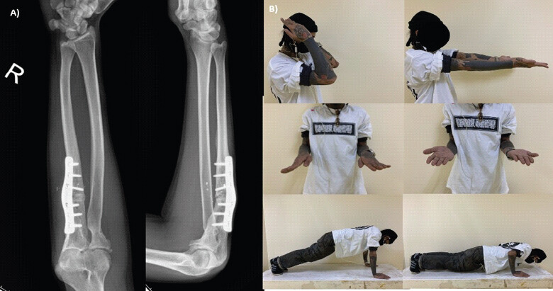 Figure 3: The radiographs demonstrated good alignment of the forearm and radiographic union. (a) The clinical pictures demonstrated range of motion of the affected limb (b).