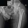 Second and Third Carpometacarpal Joint Dislocation in a Polytrauma Patient: Successful Closed Reduction and 2-Year Follow-Up