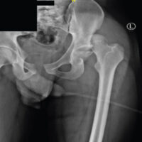 Figure 1: Pre-operative radiograph of the pelvis and left hip demonstrating posterior dislocation of the femoral head relative to the acetabulum, with associated femoral head fracture.