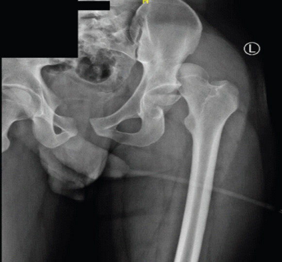 Figure 1: Pre-operative radiograph of the pelvis and left hip demonstrating posterior dislocation of the femoral head relative to the acetabulum, with associated femoral head fracture.
