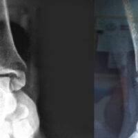 Figure 1: Emergency admission ankle anteroposterior and lateral radiographs of a 42-year-old patient with a trimalleolar fracture.