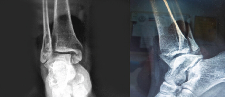 Figure 1: Emergency admission ankle anteroposterior and lateral radiographs of a 42-year-old patient with a trimalleolar fracture.