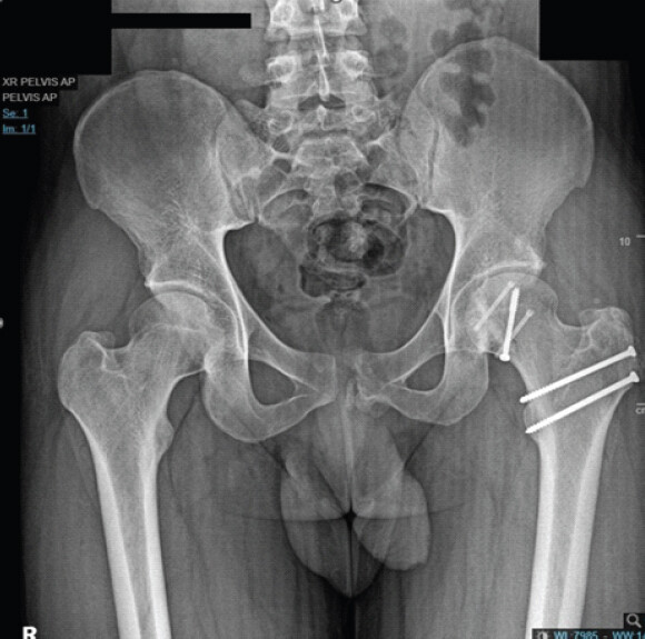 Figure 2: Post-operative anteroposterior radiograph of the pelvis demonstrating concentric reduction of the left hip joint following safe surgical dislocation and internal fixation of the femoral head fracture with headless compression screws. Joint congruity is restored with no residual subluxation.