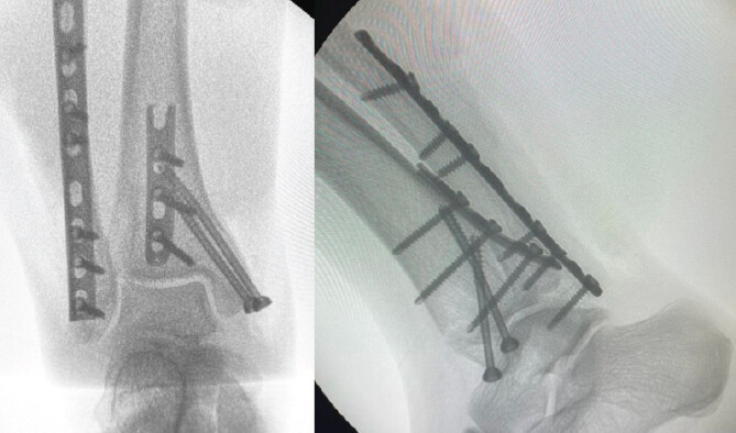 Figure 2: X-ray images taken in the operating room.