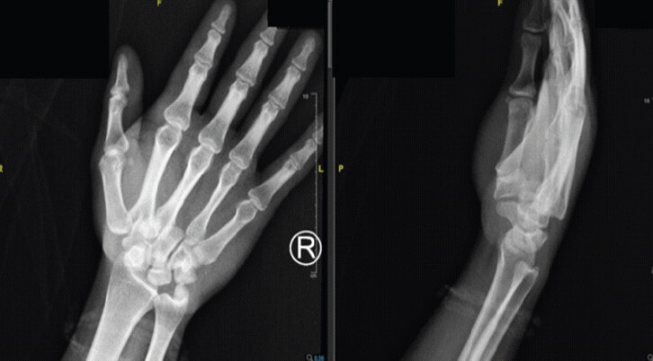 Figure 3: Radiographs of the right hand at presentation. (a) Anteroposterior view showing malalignment and loss of normal joint congruity at the second and third carpometacarpal joints, with disruption of the metacarpal–carpal alignment lines. (b) Lateral view demonstrating dorsal dislocation of the bases of the second and third metacarpals without associated fracture.