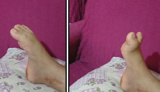 Figure 3: Checkrein deformity in the patient, which resolved during plantar flexion but appeared during dorsiflexion after cast removal at the 1-month follow-up.