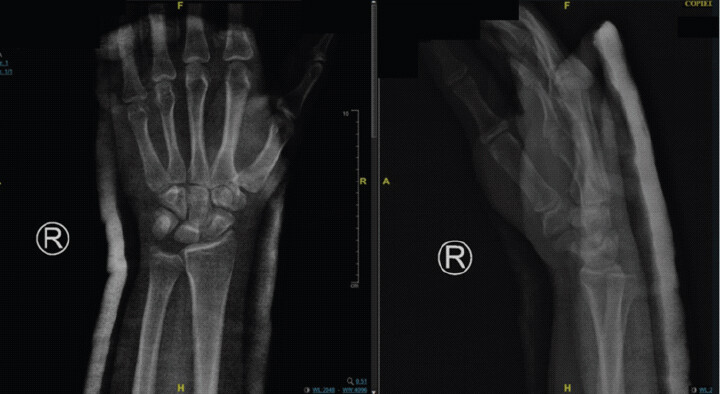 Figure 4: Post-reduction radiographs of the right hand. (a) Anteroposterior view demonstrating restoration of normal alignment and congruity of the second and third carpometacarpal joints. (b) Lateral view confirming maintained reduction without residual dorsal displacement or subluxation.