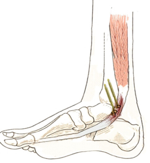 Figure 4: Schematic illustration showing flexor hallucis longus tendon impingement beneath the medial malleolar screws during dorsiflexion.