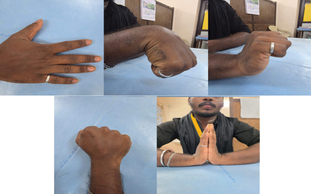 Figure 5: Clinical photographs obtained 2 years after injury demonstrating functional outcome of the right hand. Images show full finger extension, complete fist formation, preserved wrist flexion, and symmetric palm apposition, indicating restoration of normal range of motion and functional recovery without deformity.