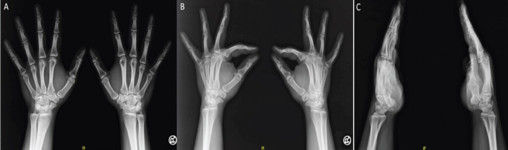 Figure 6: Radiographs of both hands obtained 2 years after injury. (a) Bilateral anteroposterior views showing maintained alignment and congruity of the carpometacarpal joints without degenerative changes. (b) Bilateral oblique views demonstrating preserved joint spaces and normal metacarpal–carpal relationships. (c) Bilateral lateral views confirming stable reduction of the second and third carpometacarpal joints with no dorsal subluxation or late displacement.
