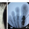 Multifactorial Non-union After First Metatarsophalangeal Arthrodesis Revised With Structural Iliac Crest Autograft: A Case Report and Comprehensive Literature Review