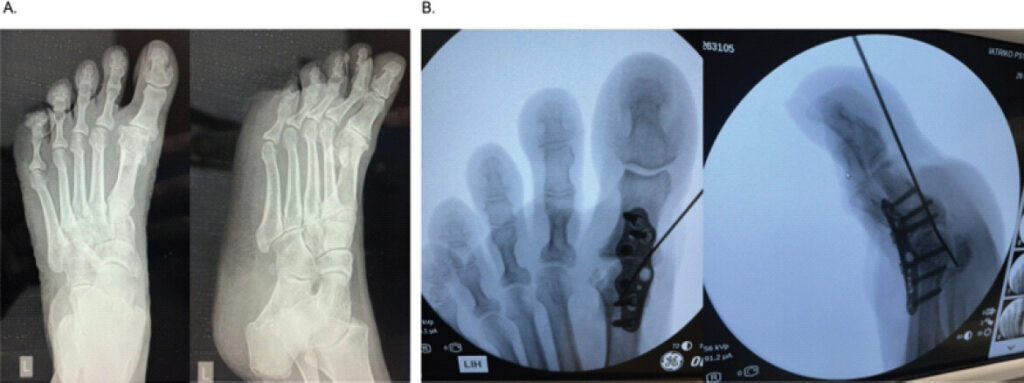 Figure 1: Pre-operative weight-bearing anteroposterior and lateral radiographs demonstrating advanced hallux rigidus with hallux varus deformity and associated second- and third-toe deformity. Intraoperative fluoroscopy following primary first metatarsophalangeal arthrodesis performed using cup-and-cone preparation and low-profile dorsal plate fixation.