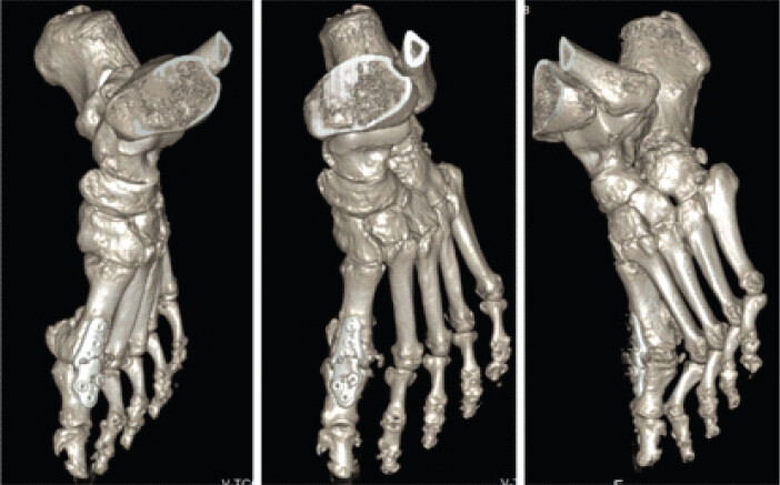 Figure 2: Failure of primary arthrodesis. Computed tomography – 3D reconstruction demonstrating established pseudarthrosis with plate breakage.