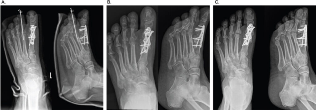 Figure 3: Revision arthrodesis. Serial post-operative anteroposterior and lateral radiographs, immediate post-operative; 3-month post-operative and 6-month post-operative radiographs demonstrating maintenance of alignment and progressive graft incorporation.
