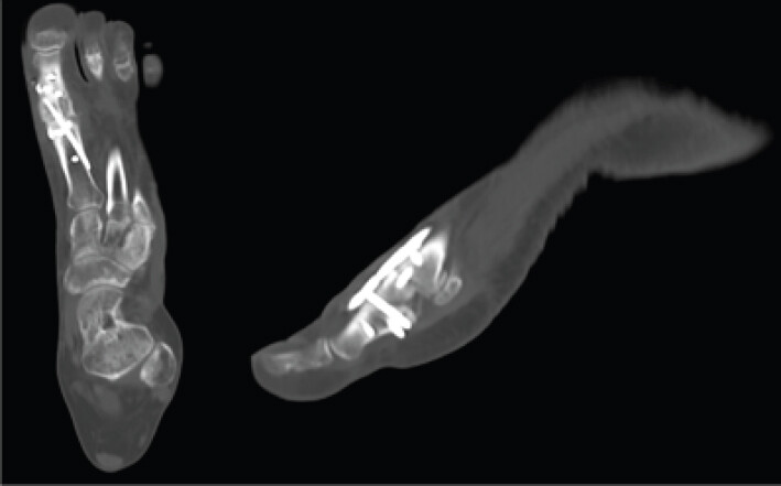 Figure 4: Six-month post-operative computed tomography demonstrating graft incorporation, bridging trabecular bone across the arthrodesis site, closure of the previous fusion gap and stable implant position.