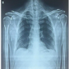 Breaking the Mold: Bilateral Lateral End Clavicle Fractures Treated with Dog Bone Button Fixation – A Rare Case