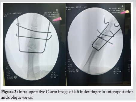 Dynamic External Fixation Using Suzuki Frame for Intra-articular Middle ...