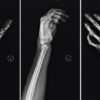 Concomitant Distal Radius Fracture, Scaphoid Fracture, and Pisiform Dislocation with Ulnar Nerve Neuropraxia: A Case Report with Biomechanical Analysis
