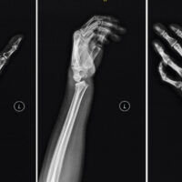 Figure 1: X-ray of the left wrist at presentation: (a) Anteroposterior view, (b) lateral view, and (c) scaphoid view showing an extra-articular distal radius fracture with dorsal angulation and a scaphoid waist fracture.