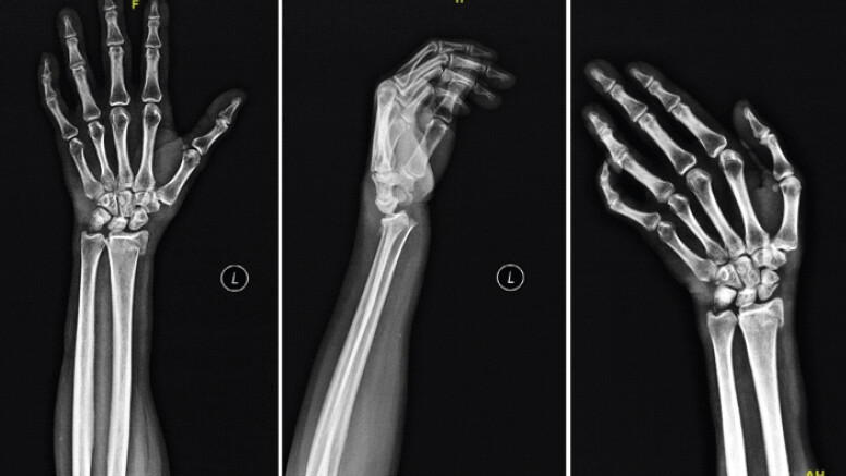 Figure 1: X-ray of the left wrist at presentation: (a) Anteroposterior view, (b) lateral view, and (c) scaphoid view showing an extra-articular distal radius fracture with dorsal angulation and a scaphoid waist fracture.