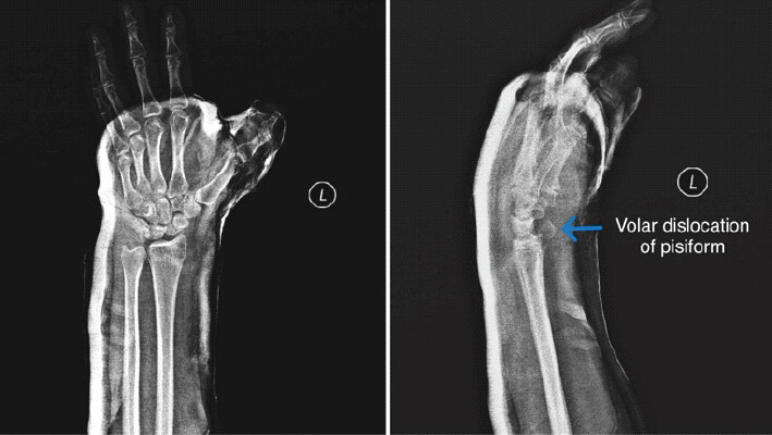 Figure 2: X-ray of the left wrist after splinting: (a) Anteroposterior view, (b) lateral view showing a dislocated pisiform (arrow). Note the volar displacement of the pisiform away from its normal articulation with the triquetrum on the lateral view.