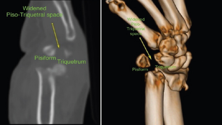 Figure 3: (a and b) Non-contrast computed tomography wrist (sagittal sections) with 3D reconstruction demonstrating volar migration of the pisiform relative to the triquetrum (arrows). Note the complete loss of pisotriquetral articular congruity and marked widening of the joint space, consistent with a volar dislocation pattern.