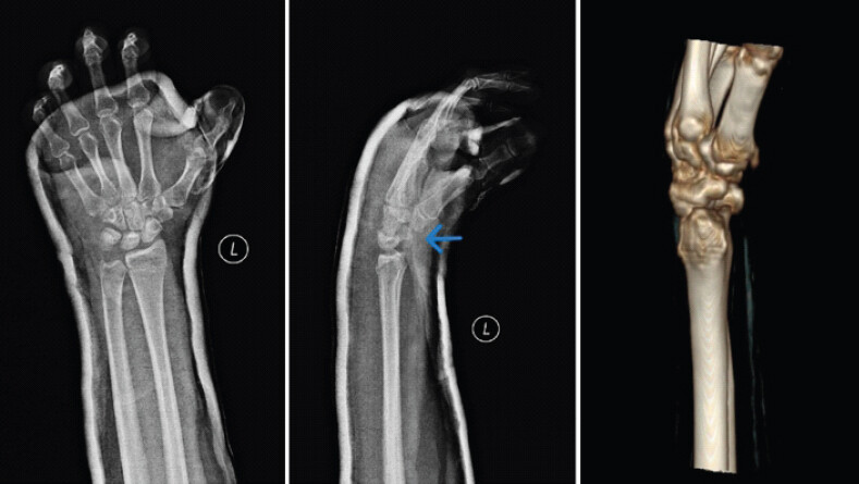 Figure 4: X-ray of the left wrist post-reduction: (a) Anteroposterior view, (b) lateral view and (c) non-contrast computed tomography 3D reconstruction showing reduced pisiform (arrow), maintained distal end radius reduction, and undisplaced scaphoid waist fracture.