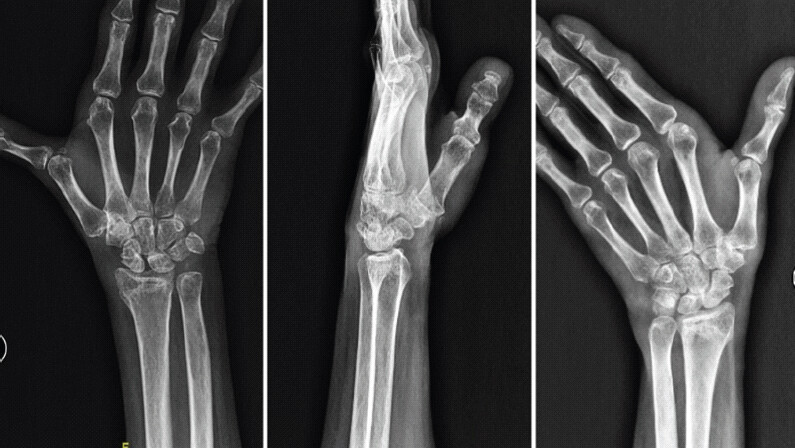 Figure 5: Nine-month follow-up radiographs of the left wrist: (a) Anteroposterior, (b) lateral, and (c) scaphoid view showing union of distal end radius fracture and scaphoid fracture with maintained pisiform reduction.
