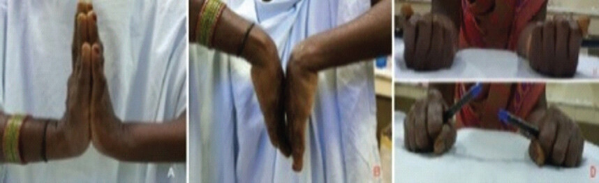 Figure 6: (a-c) Nine-month follow-up clinical photographs showing good wrist range of motion: Dorsiflexion, palmar flexion, supination, and pronation of the left wrist.