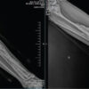Melorheostosis of the Right Lower Limb Presenting as Progressive Painful Swelling in a Young Adult: A Case Report