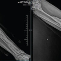 Figure 1: X-ray of the right leg (anteroposterior and lateral views) showing cortical hyperostosis with “flowing candle wax appearance.”