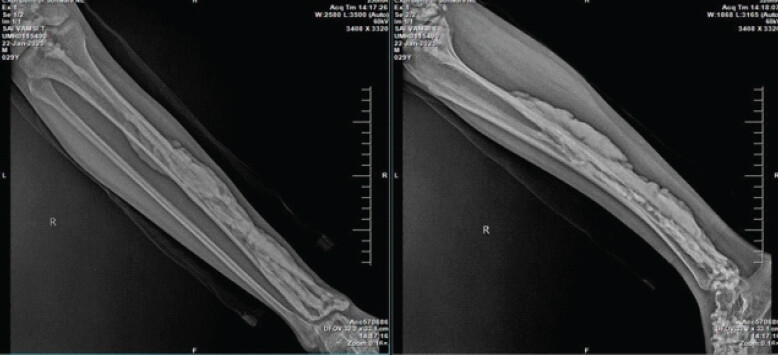 Figure 1: X-ray of the right leg (anteroposterior and lateral views) showing cortical hyperostosis with “flowing candle wax appearance.”