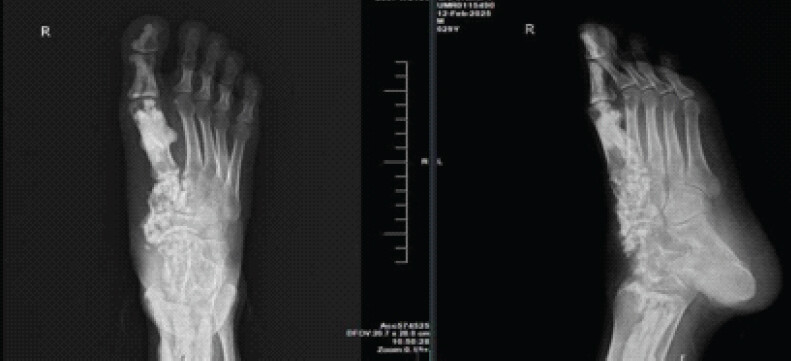 Figure 2: X-ray of right foot (anteroposterior and lateral views) showing irregular cortical thickening and sclerosis.