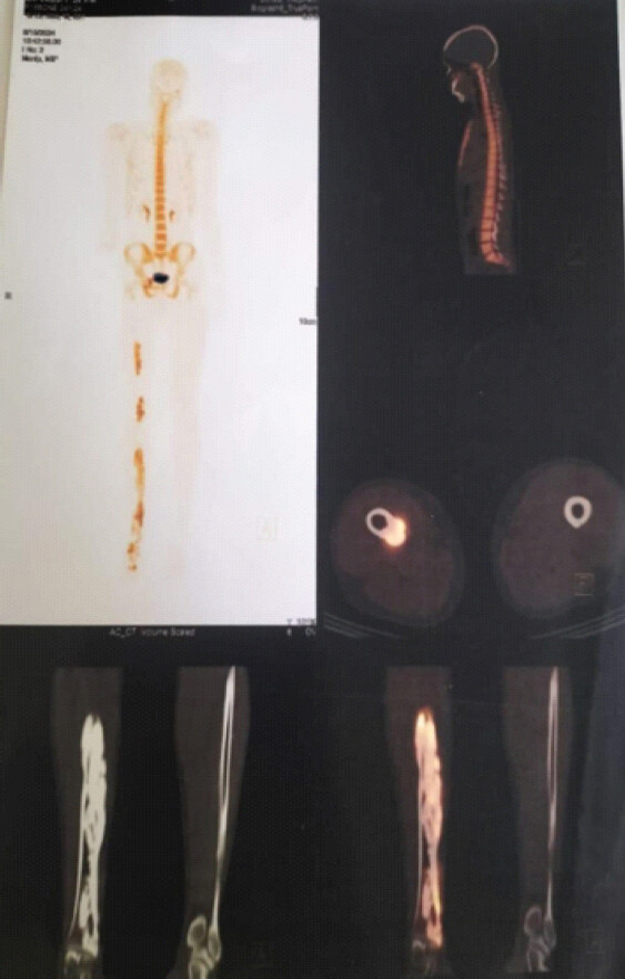 Figure 3: Bone scan image.