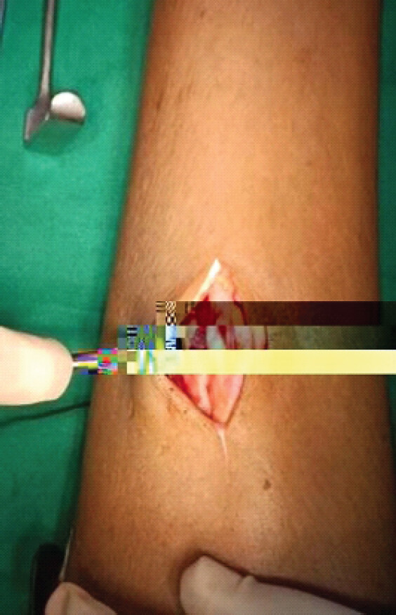 Figure 4: Intraoperative biopsy image.