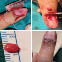 Figure 1: Intraoperative steps of subungual glomus tumor excision: (a) Nail plate elevation, (b) tumor exposure and dissection, (c) excised tumor specimen (~0.5 cm), and (d) post-operative closure. Personal clinical case, 2024.