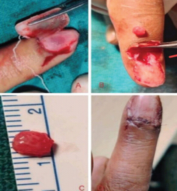 Figure 1: Intraoperative steps of subungual glomus tumor excision: (a) Nail plate elevation, (b) tumor exposure and dissection, (c) excised tumor specimen (~0.5 cm), and (d) post-operative closure. Personal clinical case, 2024.