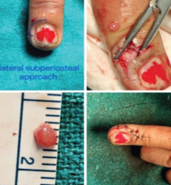 Figure 2: (a-d) Intraoperative images showing lateral subperiosteal approach for excision of subungual glomus tumor of the finger. Personal clinical case, 2024.