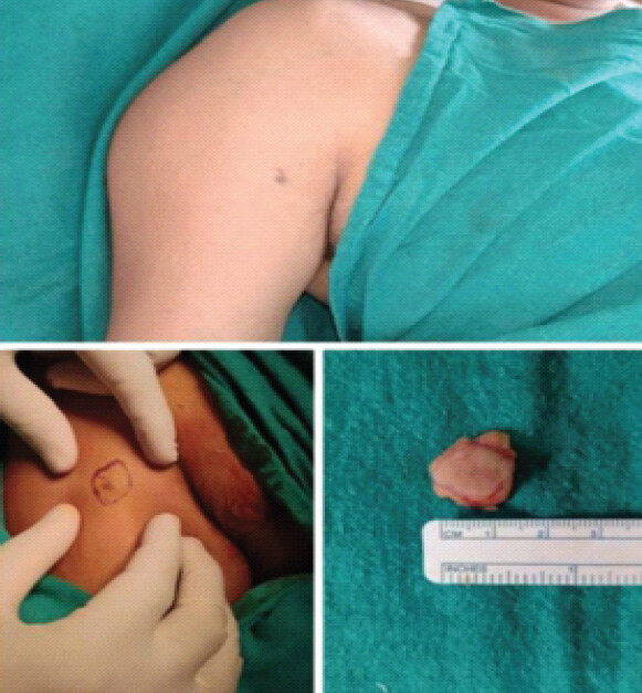 Figure 3: (a-c) Pre-operative marking for wide local excision, intraoperative excision, and excised specimen from the upper arm. Original clinical photograph.
