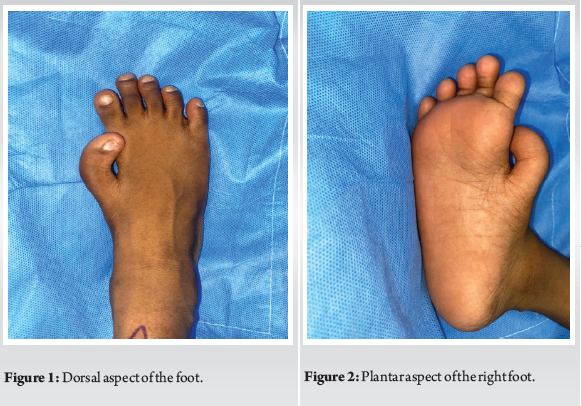 Rare Toes A Rare Footprint: A Case Report of Isolated Pre-Axial Fully Developed ...
